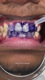 Hismile - Teeth Brightening Serum V34 - Image 7